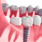 Best Dental Implant Support Supplements For The Elderly