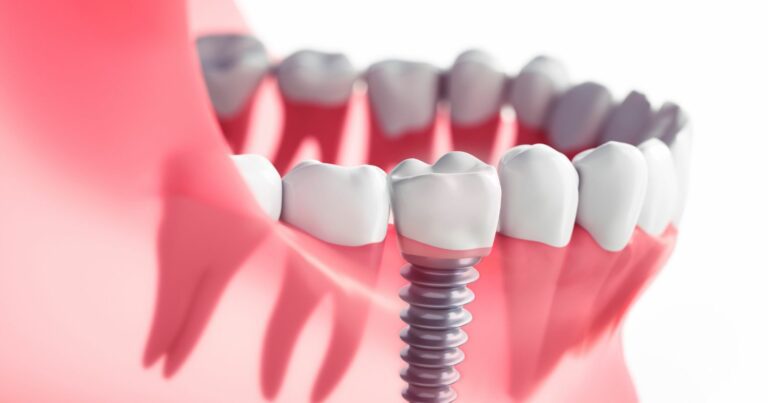 3 Best Dental Implant Support Supplements For The Elderly