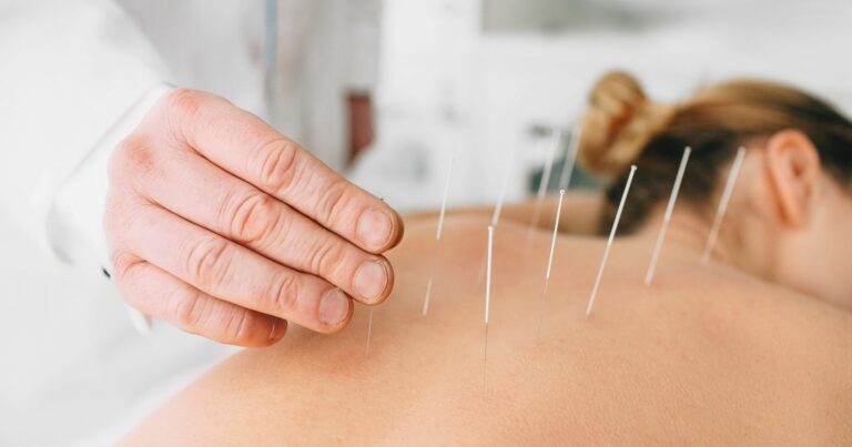 Does Medicare Cover Acupuncture?