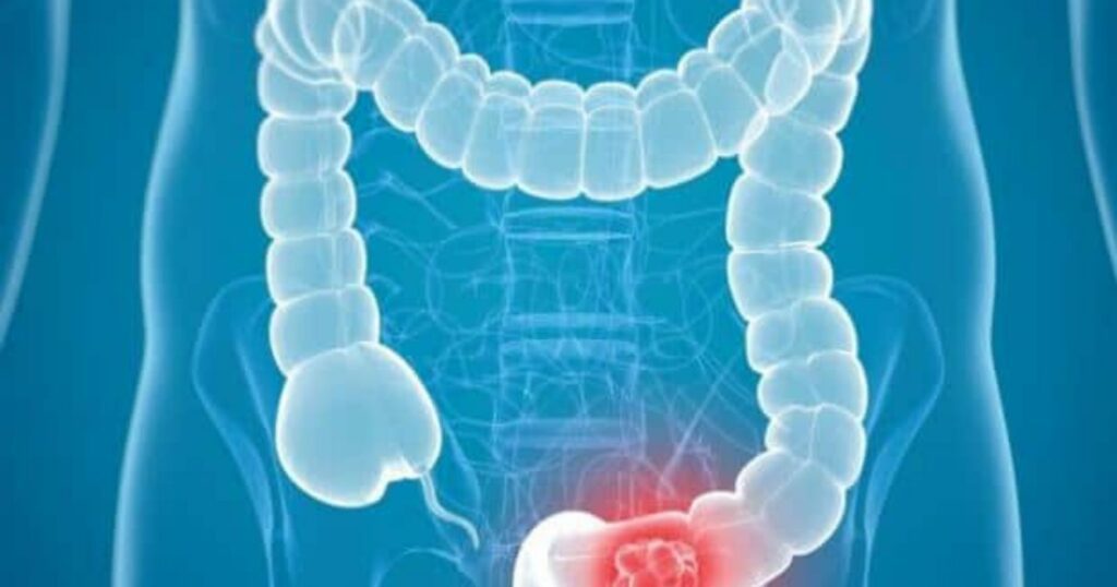 Does Medicare Cover Colonoscopy For Seniors? Elderly Independence