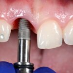 Does Medicare Cover Dental Implants For Seniors