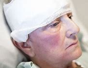 Why Is My Elderly Mother So Negative | head injury 2222