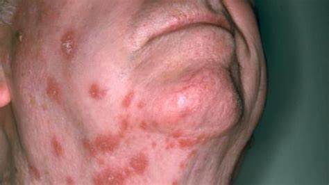 3 Best Treatments For Shingles – For The Elderly | side effects