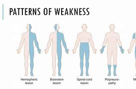 Neurological disorders and weak legs in the elderly